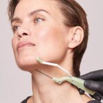 FaceTite cannula delivering radiofrequency energy to the jawline and neck