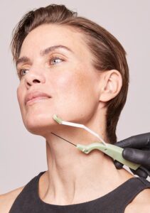 FaceTite cannula delivering radiofrequency energy to the jawline and neck