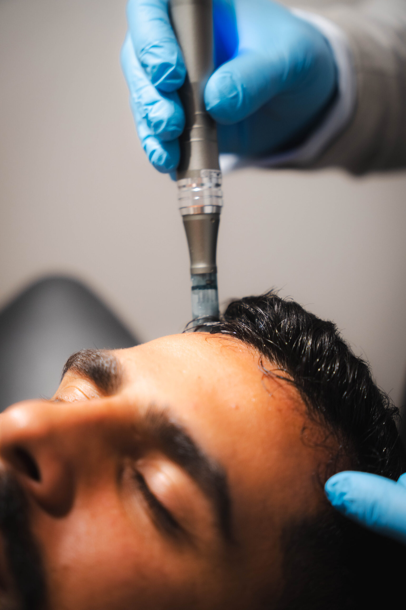 Hair restoration treatment being carried out at TCMA
