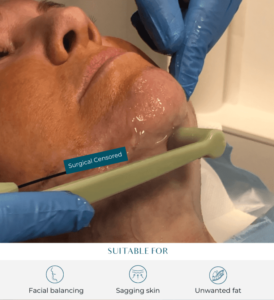 FaceTite suitable for facial balancing, sagging skin and unwanted fat