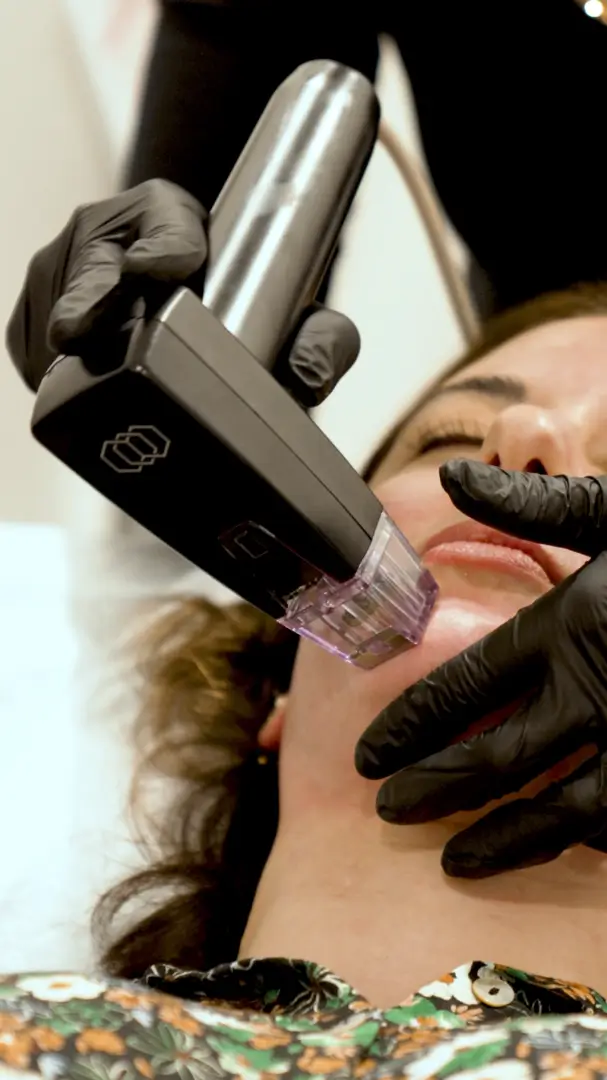 Radiofrequency microneedling handpiece in use at TCMA