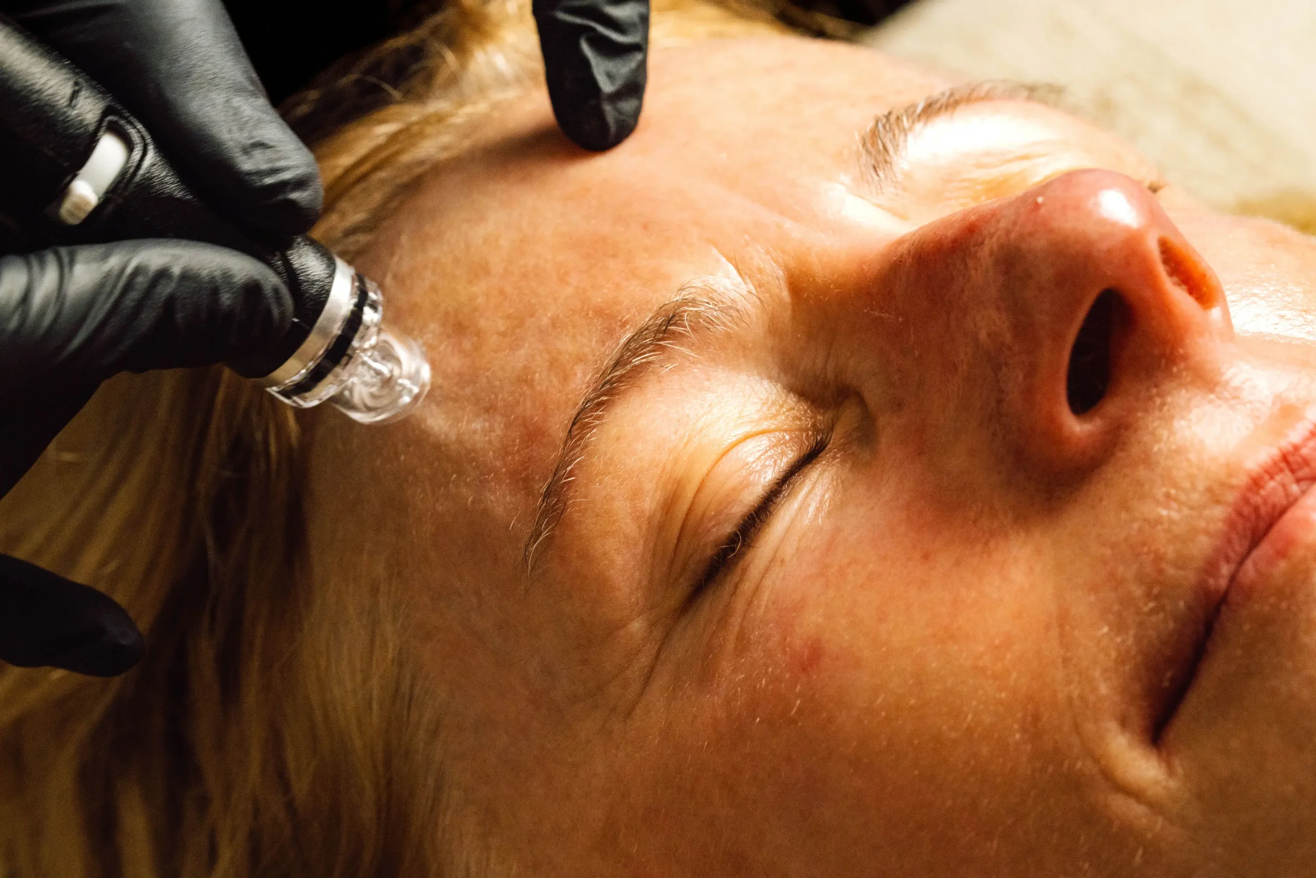 HydraFacial treatment for congestion at The Centre for Medical Aesthetics, Surry Hills