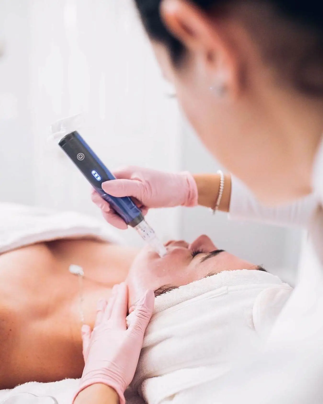 SkinPen microneedling for acne scarring at The Centre for Medical Aesthetics, Surry Hills