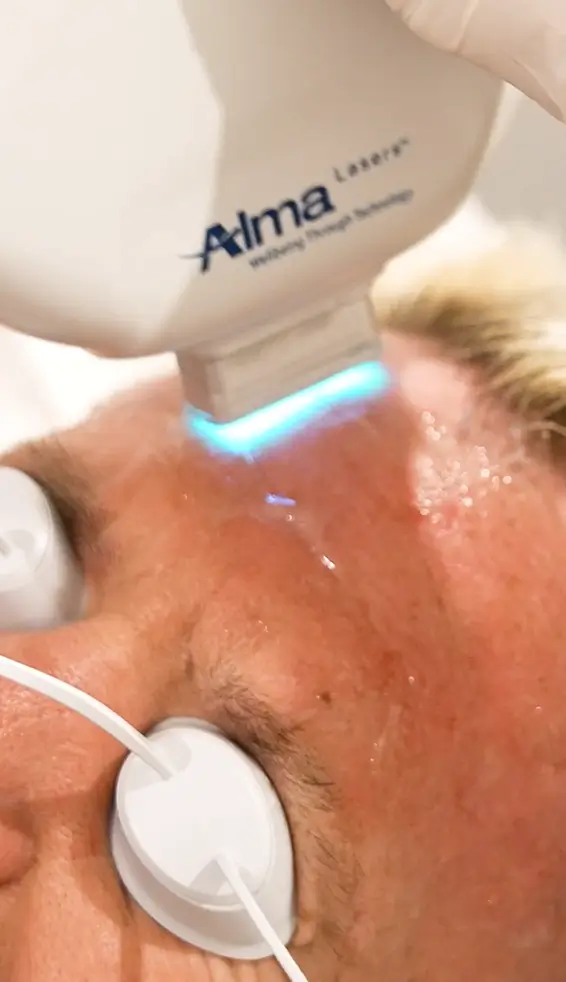 Alma HarmonyXL treatment at TCMA in Surry Hills