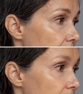 anti wrinkle injections before and after