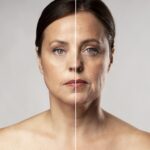 anti wrinkle injections before and after