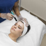 how many microneedling sessions for acne scars