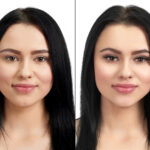 thread lift before after