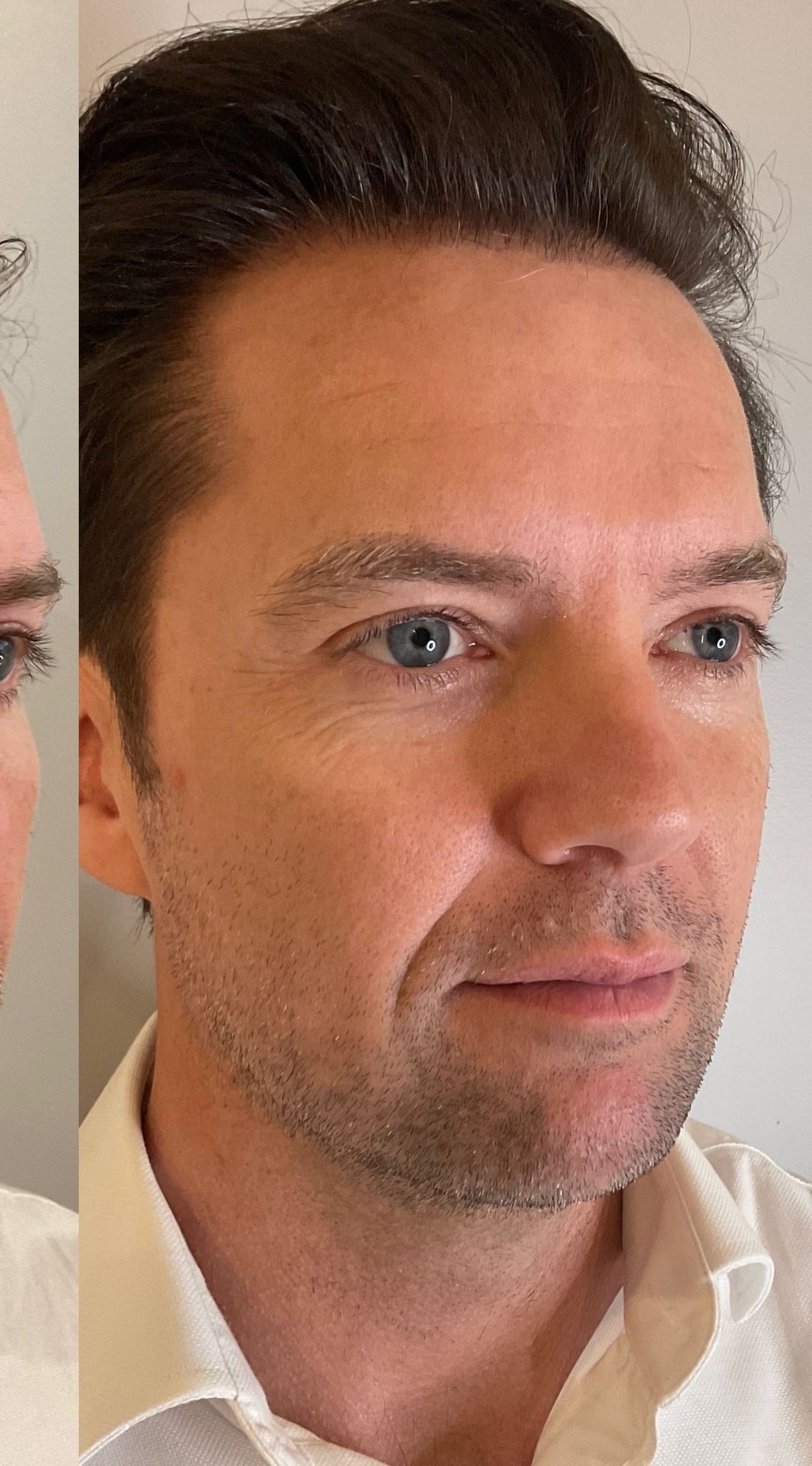 Male patient at The Centre for Medical Aesthetics, Surry Hills